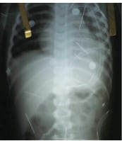 Black Magic Responsible for Needles Found Inside Brazilian Toddler